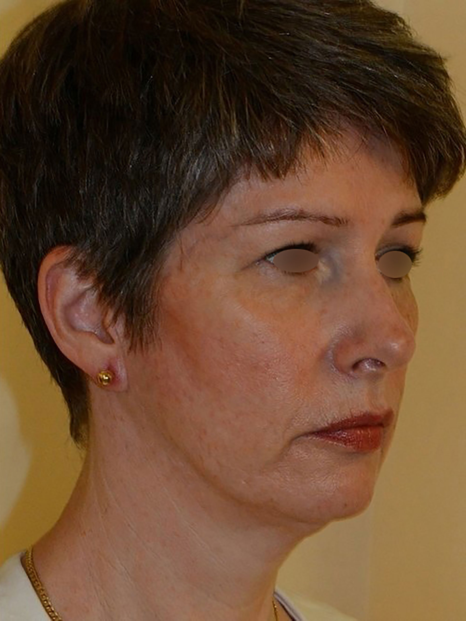 Підтяжка обличчя, після процедури