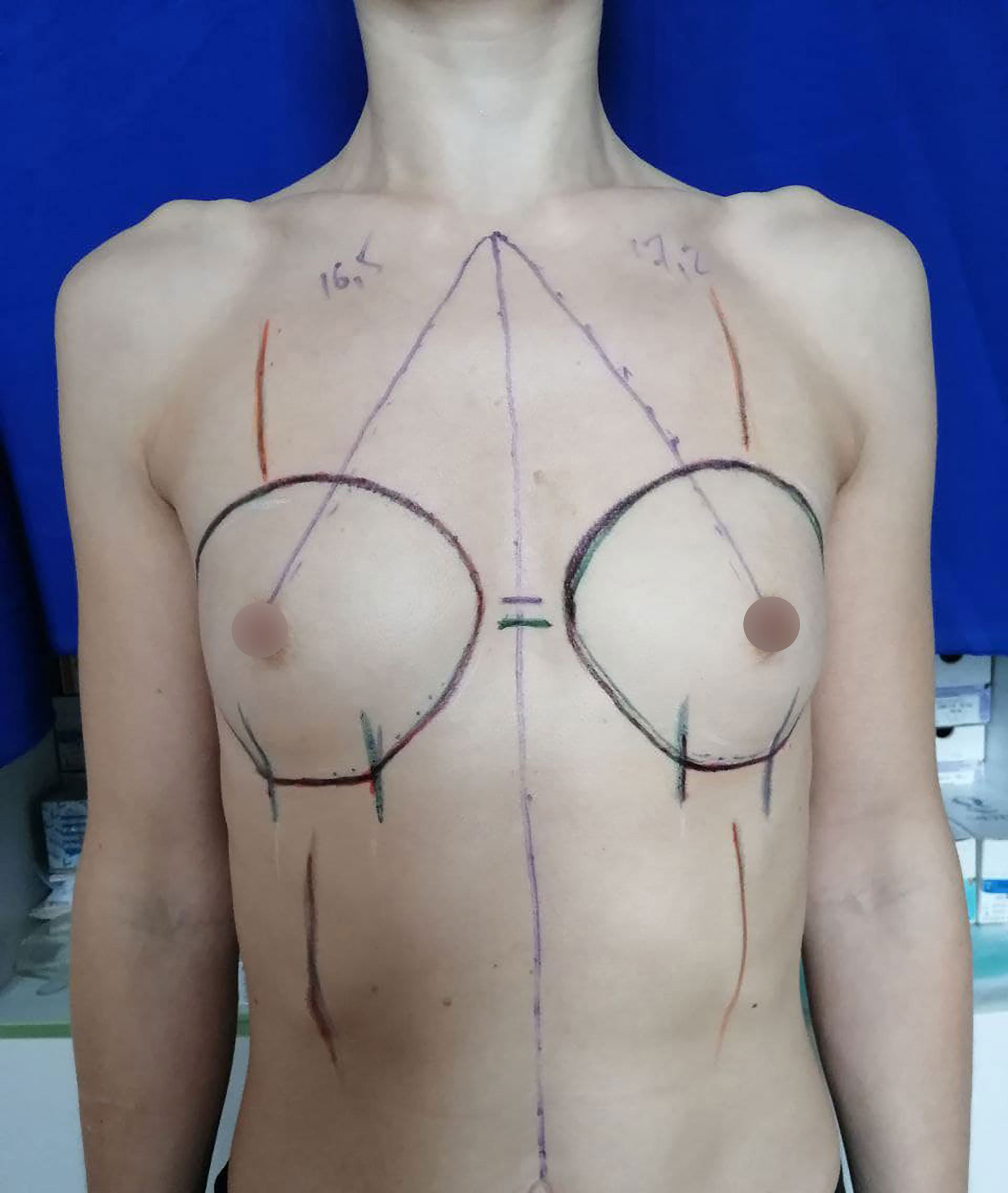 Аугментаційна маммопластика. Імпланти Motiva Anatomical 285 мл встановлені під м’яз, до процедури